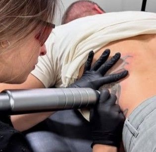 Procedimento de remoção de tatuagem a laser